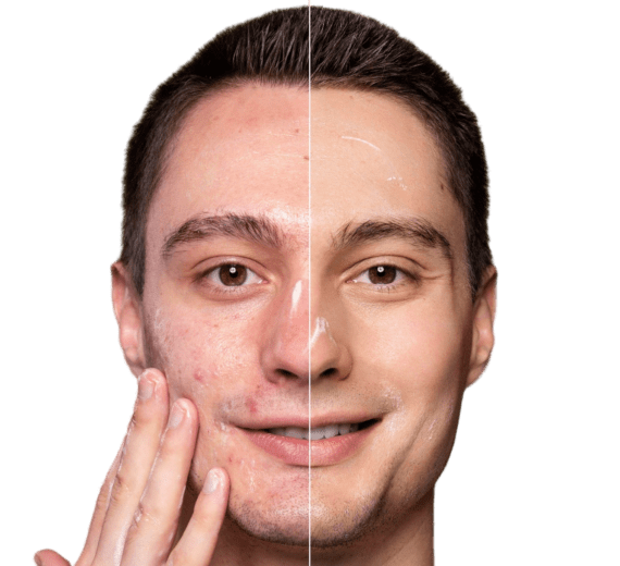 درمان تخصصی لک و جای جوش دکتر پاردس