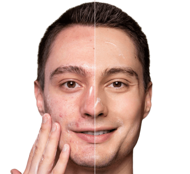 درمان تخصصی لک و جای جوش دکتر پاردس