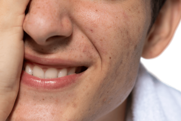 درمان تخصصی لک و جای جوش زیبایی دکتر پاردس