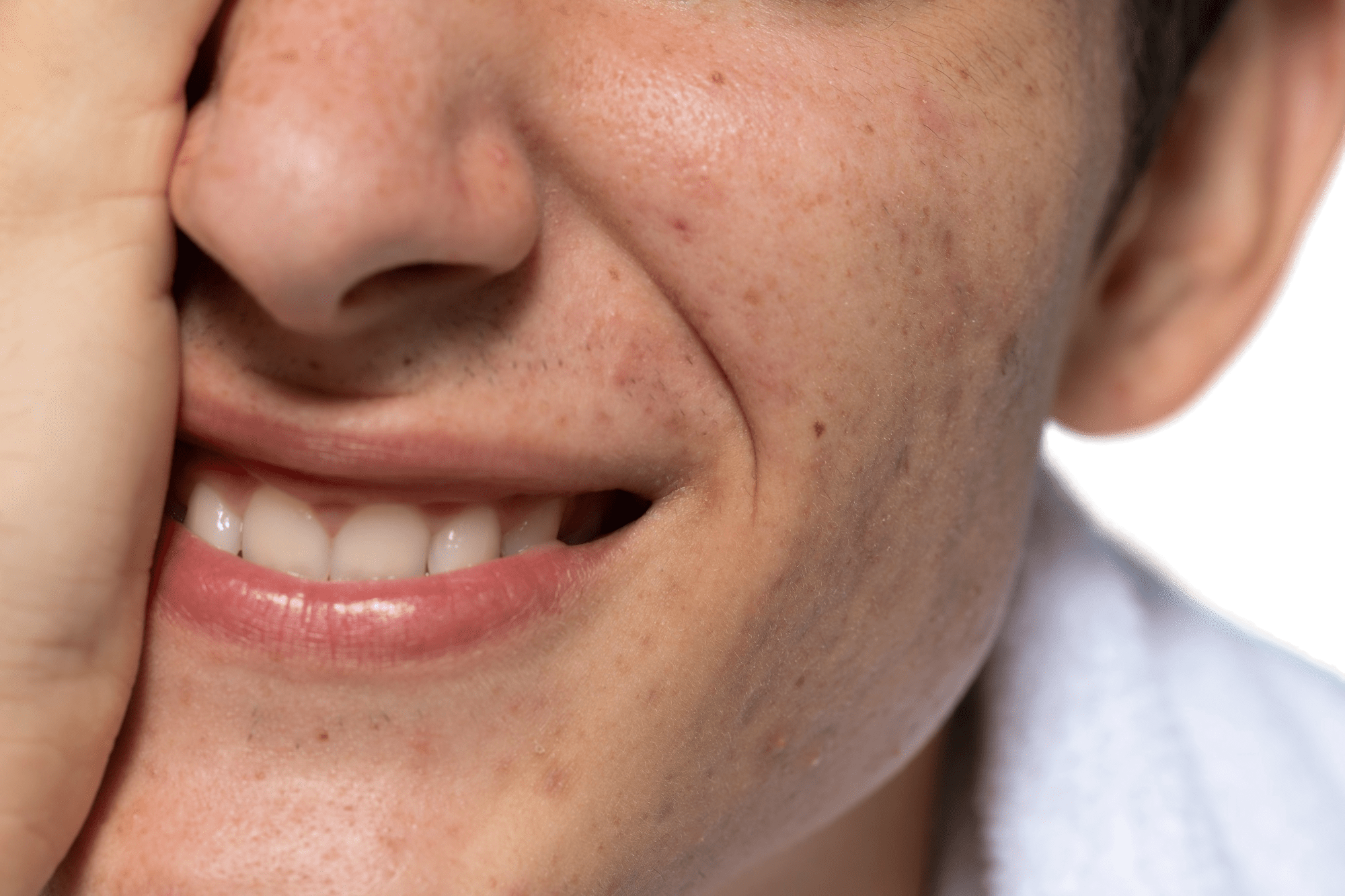 درمان تخصصی لک و جای جوش زیبایی دکتر پاردس