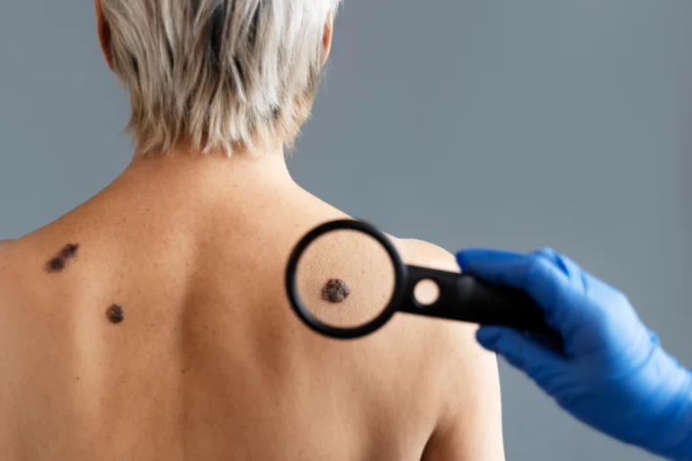 سرطان پوست سلول سنگفرشی