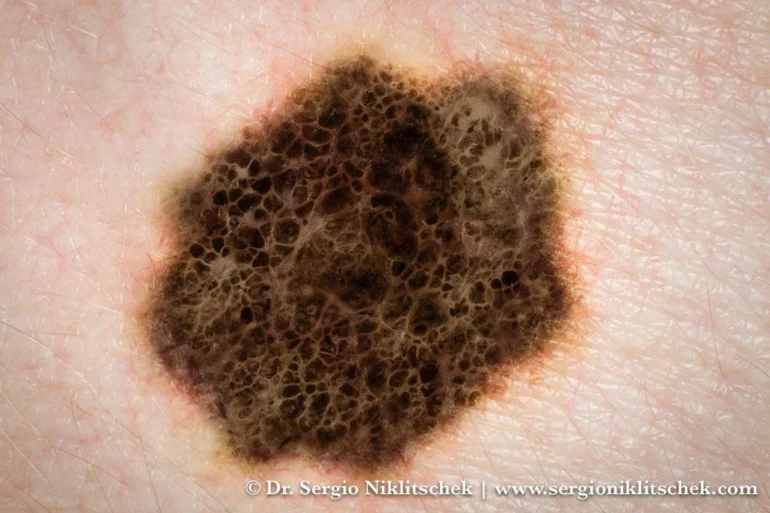 ملانوما چیست؟ - زیبایی دکتر پاردس