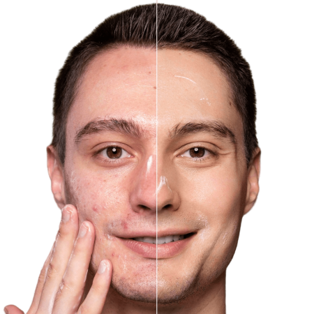 درمان تخصصی لک و جای جوش​ دکتر پاردس